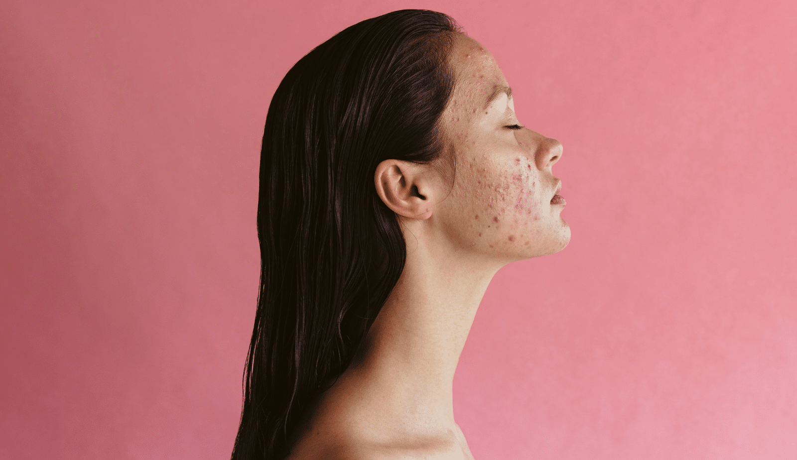 Adult Acne: Navigating your Skin Care Journey